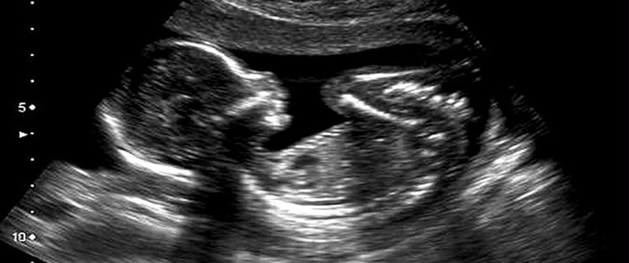 Gentrix - Estudio Genético - Embarazo - Ecografía con Scan Fetal