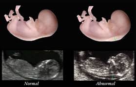 Gentrix Estudios Genéticos durante el Embarazo Medicina Genética Scan Fetal